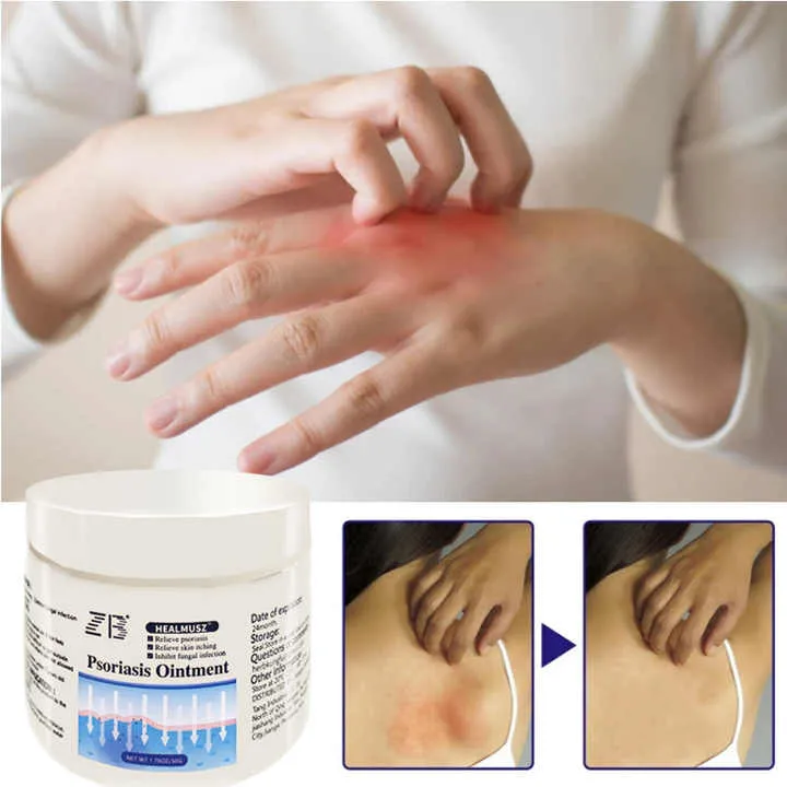 ZB Psoriasis Cream for Dermatitis and- لعلاج الصدفية والتهاب